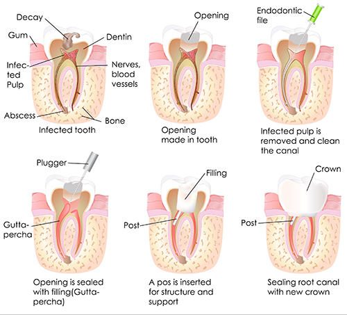 Root Canal Therapy near Englewood Cliffs